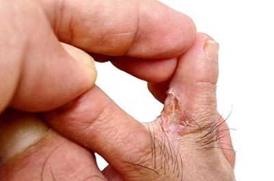 Expert Guidance From a Podiatrist on Athlete’s Foot