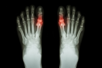 How Podiatrists Can Test for Gout